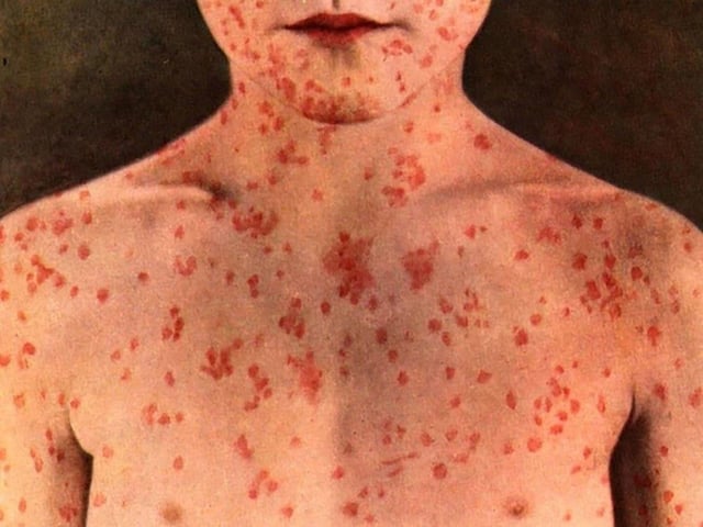 Measles Outbreak in Northern Nova Scotia: 30 Cases Confirmed