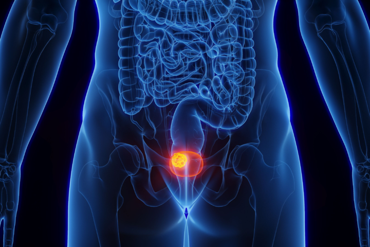 Breakthrough Treatment TAR-200 Achieves 82% Success in Bladder Cancer